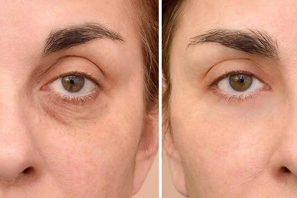 تزریق فیلر زیر چشم معجزه ای برای برطرف کردن گودی و تیرگی زیر چشم