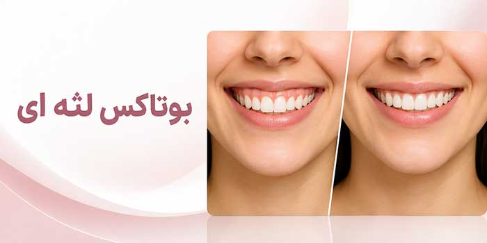 بوتاکس لثه چیست؟